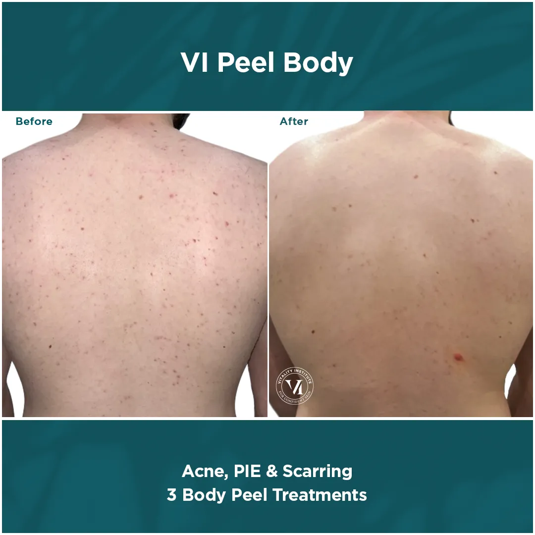 Back Acne, PIE & Scarring — 3 VI Peel Body Treatments