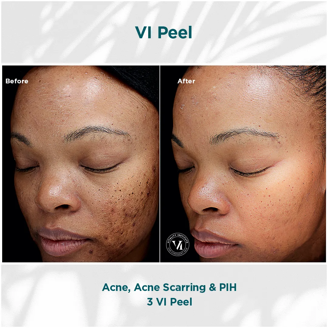 Melasma & Fine Lines — VI Peel Precision + Peptides, 3 Sessions (Strip)