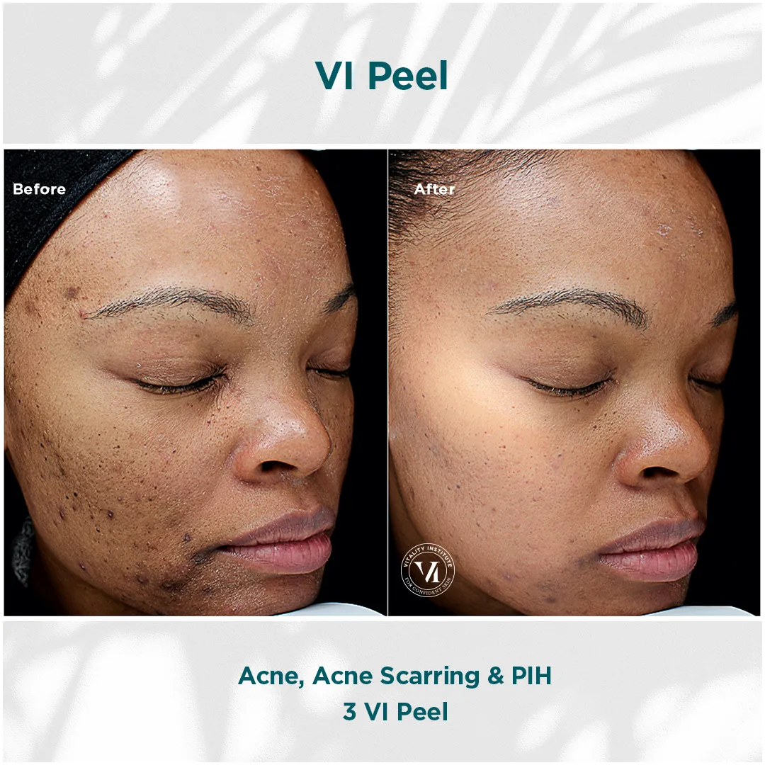 Acne, Acne Scarring & PIH — 3 VI Peel (Deep Skin Tone II)