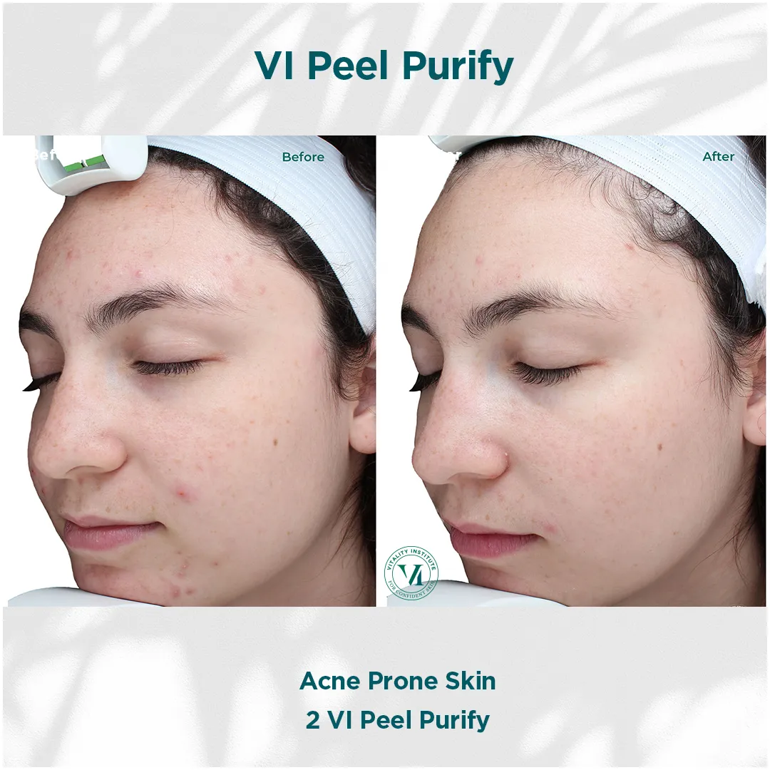 Acne Prone Skin — 2 VI Peel Purify
