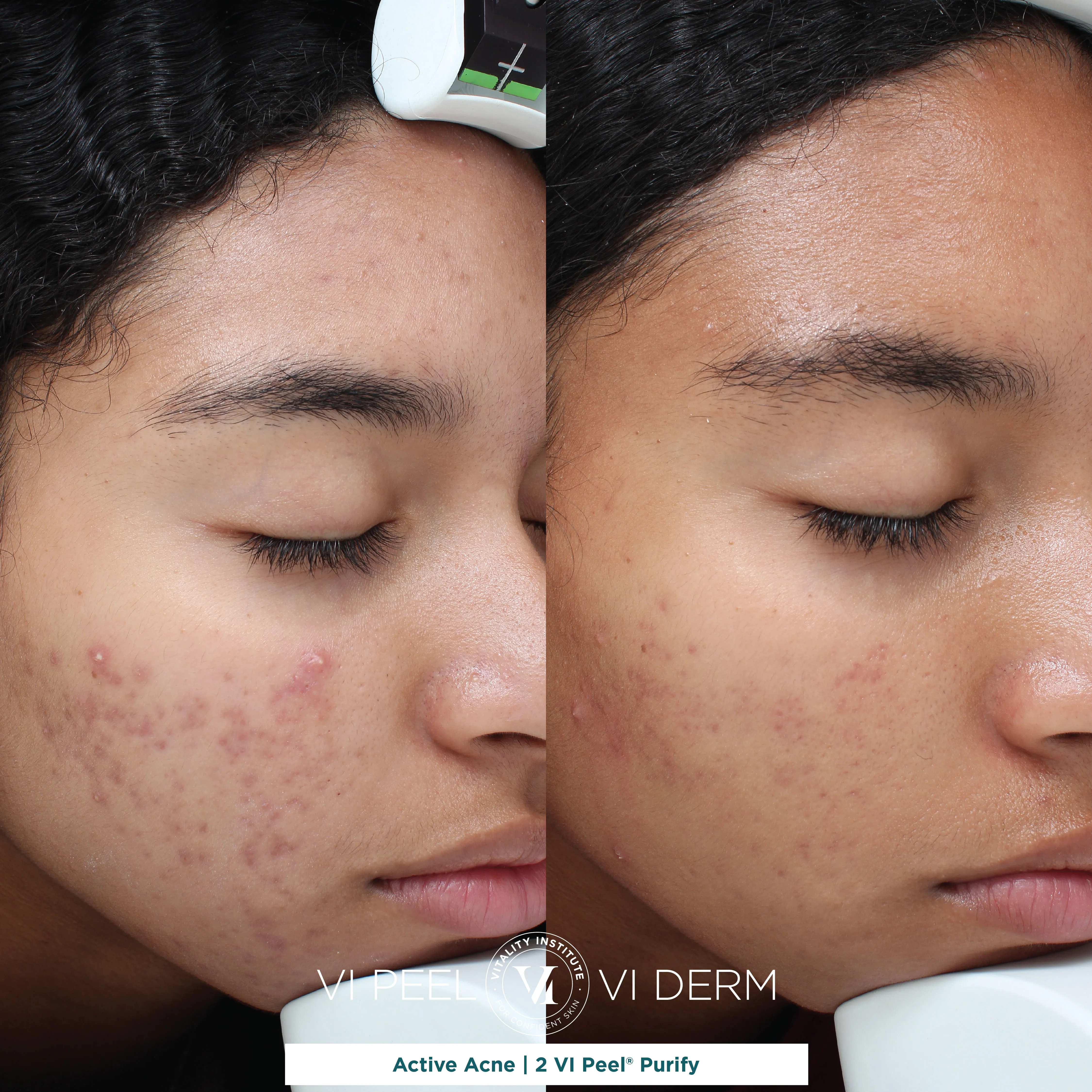 Active Acne — 2 VI Peel Purify