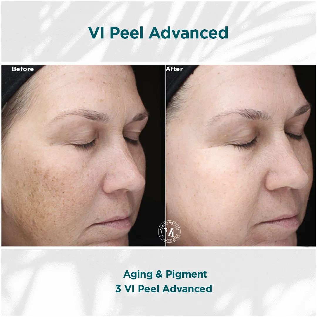 Aging & Pigment — 3 VI Peel Advanced