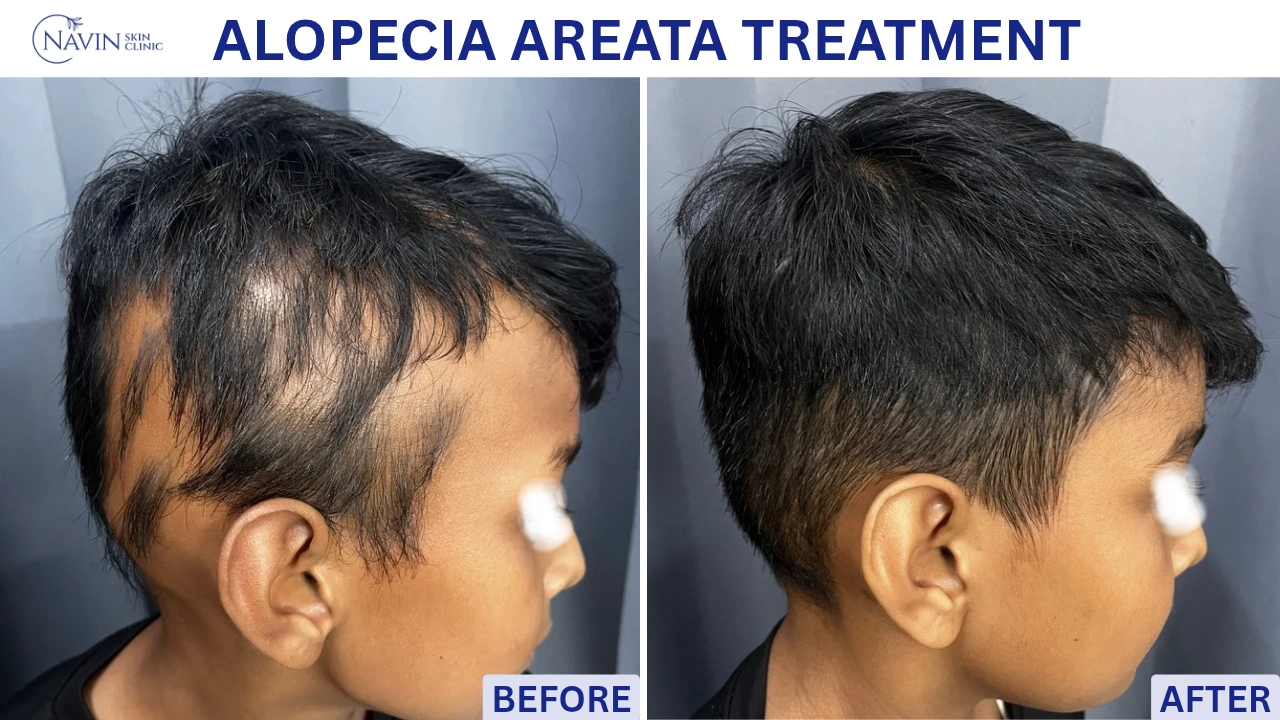 Alopecia Areata Treatment - Before