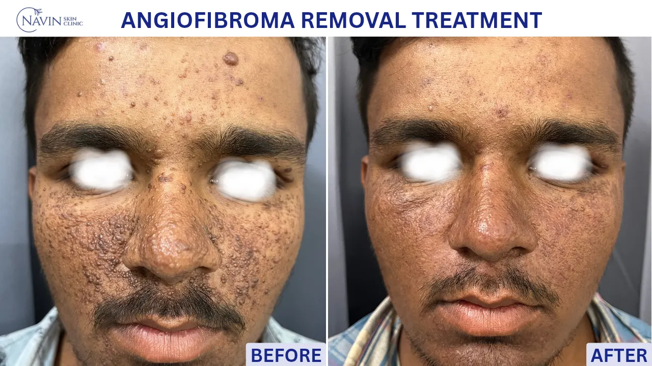 Angiofibroma Removal Treatment - Before