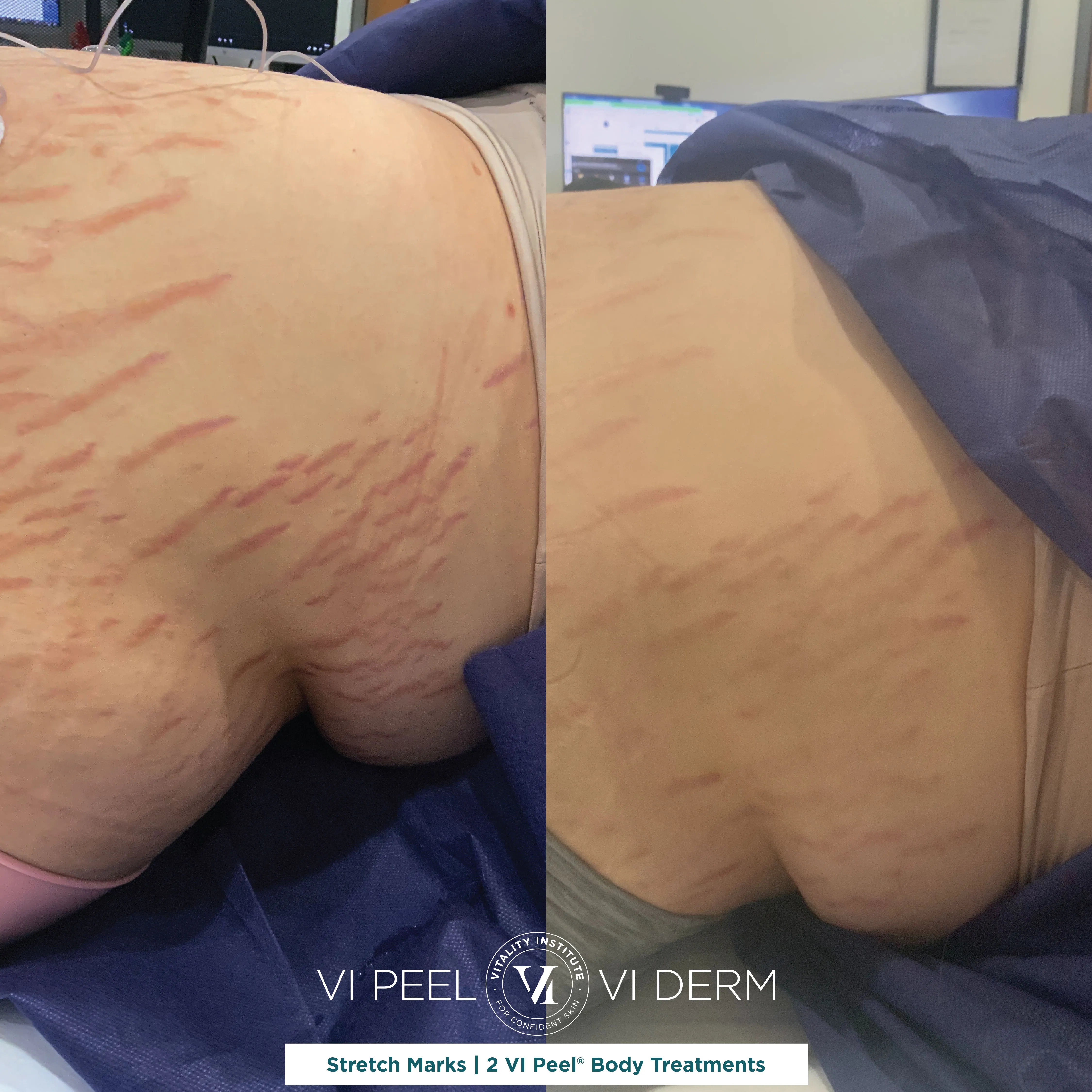 Stretch Marks — Abdomen, 2 VI Peel Body Treatments