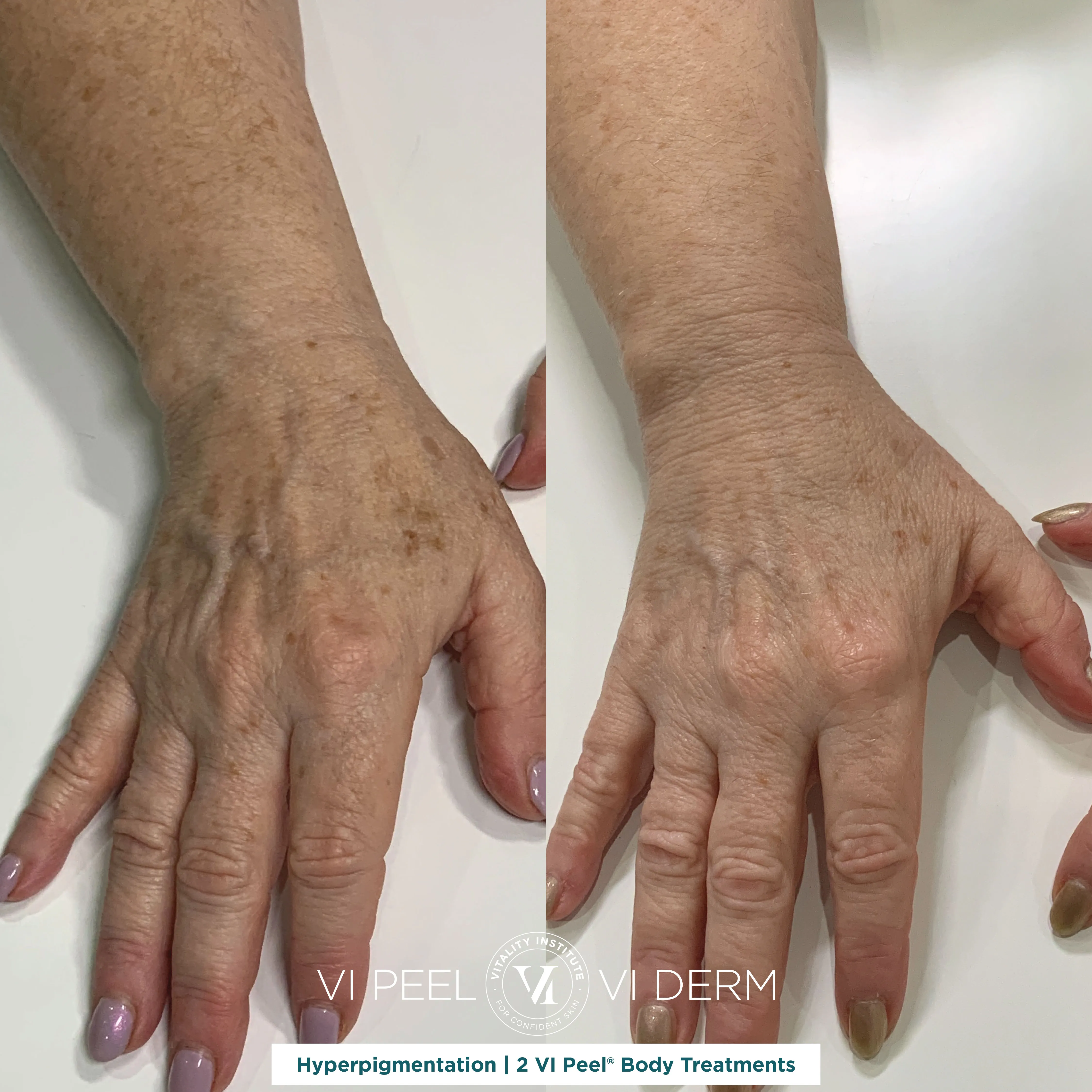 Hyperpigmentation — Hands & Arms, 2 VI Peel Body Treatments