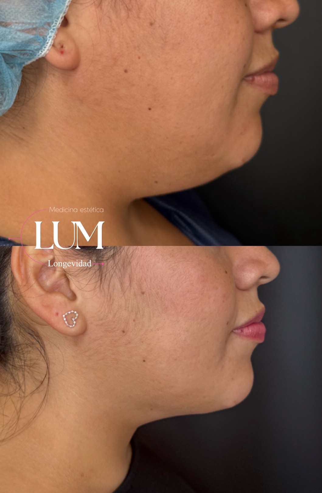 Antes y despues - Perfilado de mandibula