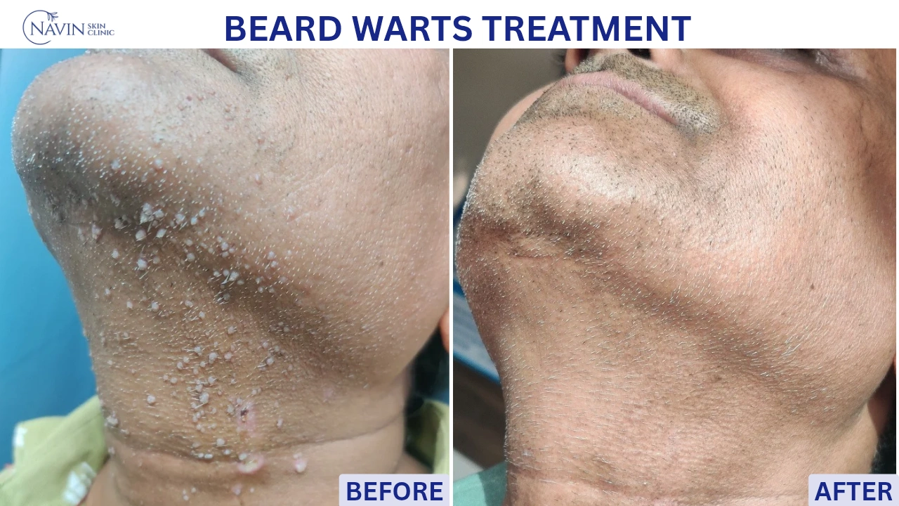 Beard Warts Treatment - Before