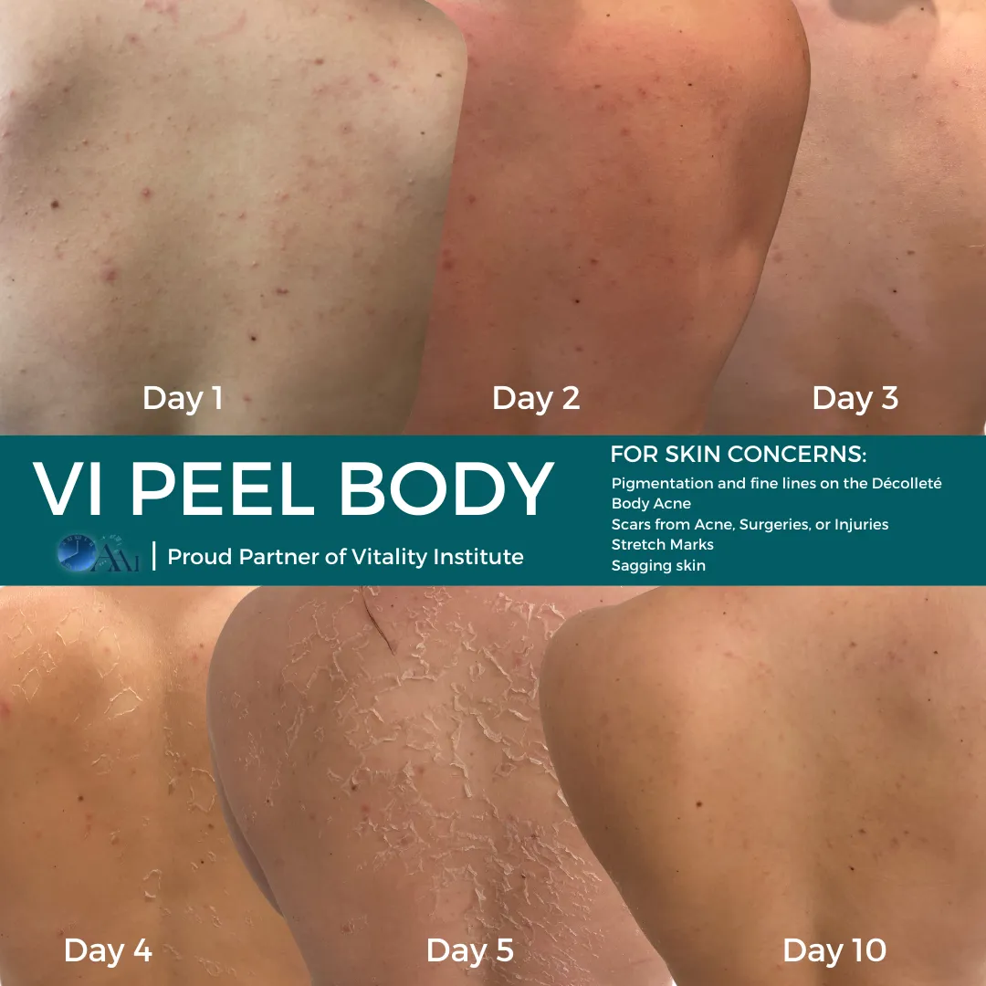 Day 1–10 Progression — VI Peel Body (Back Acne)
