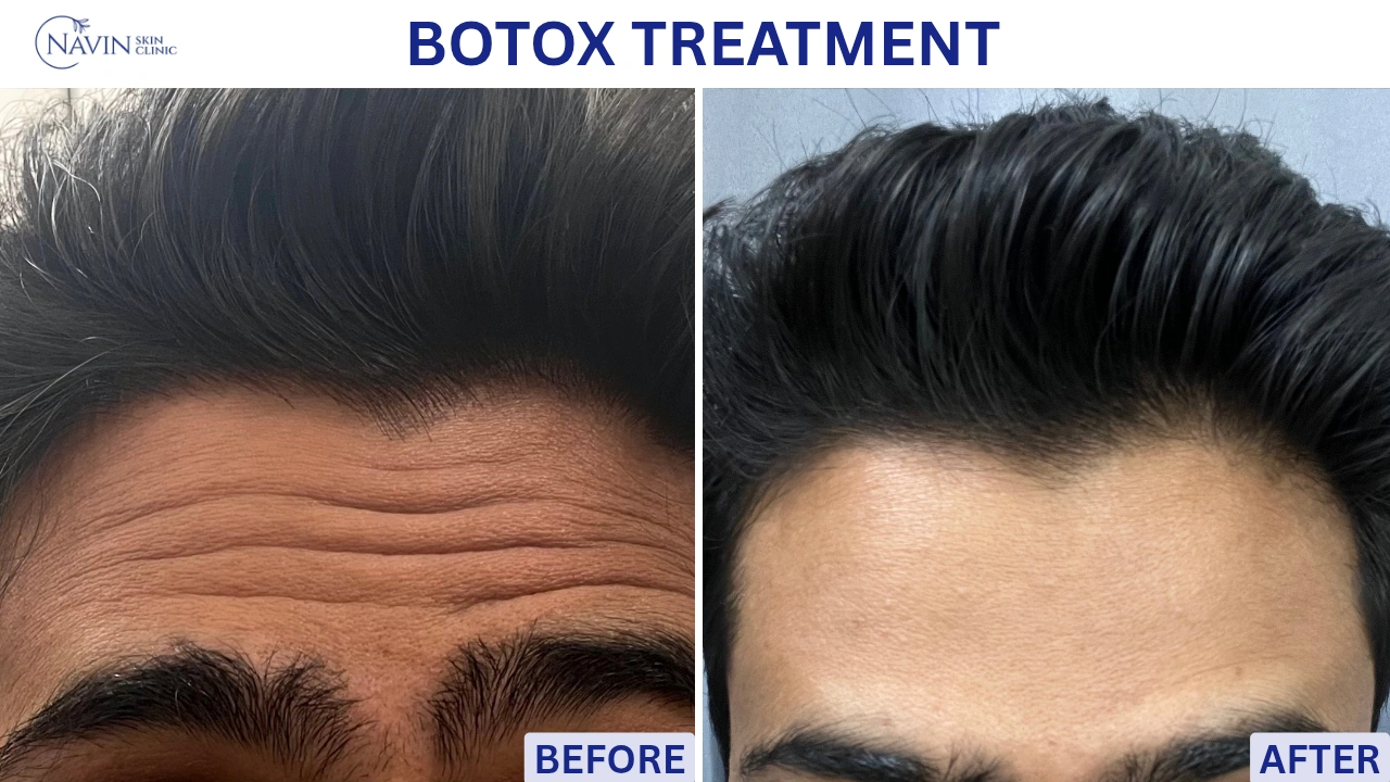 Botox Treatment - Before