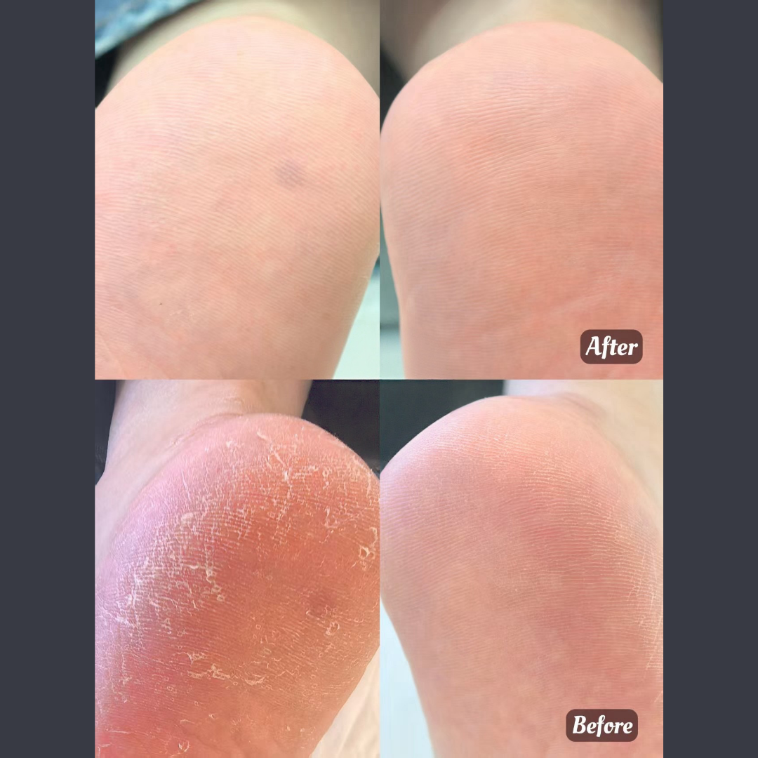 Before and after callus treatment showing smooth heel transformation by Colour Workshop Singapore