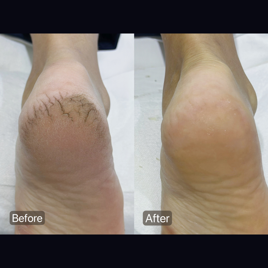 Side-by-side before and after callus treatment results by Colour Workshop Singapore