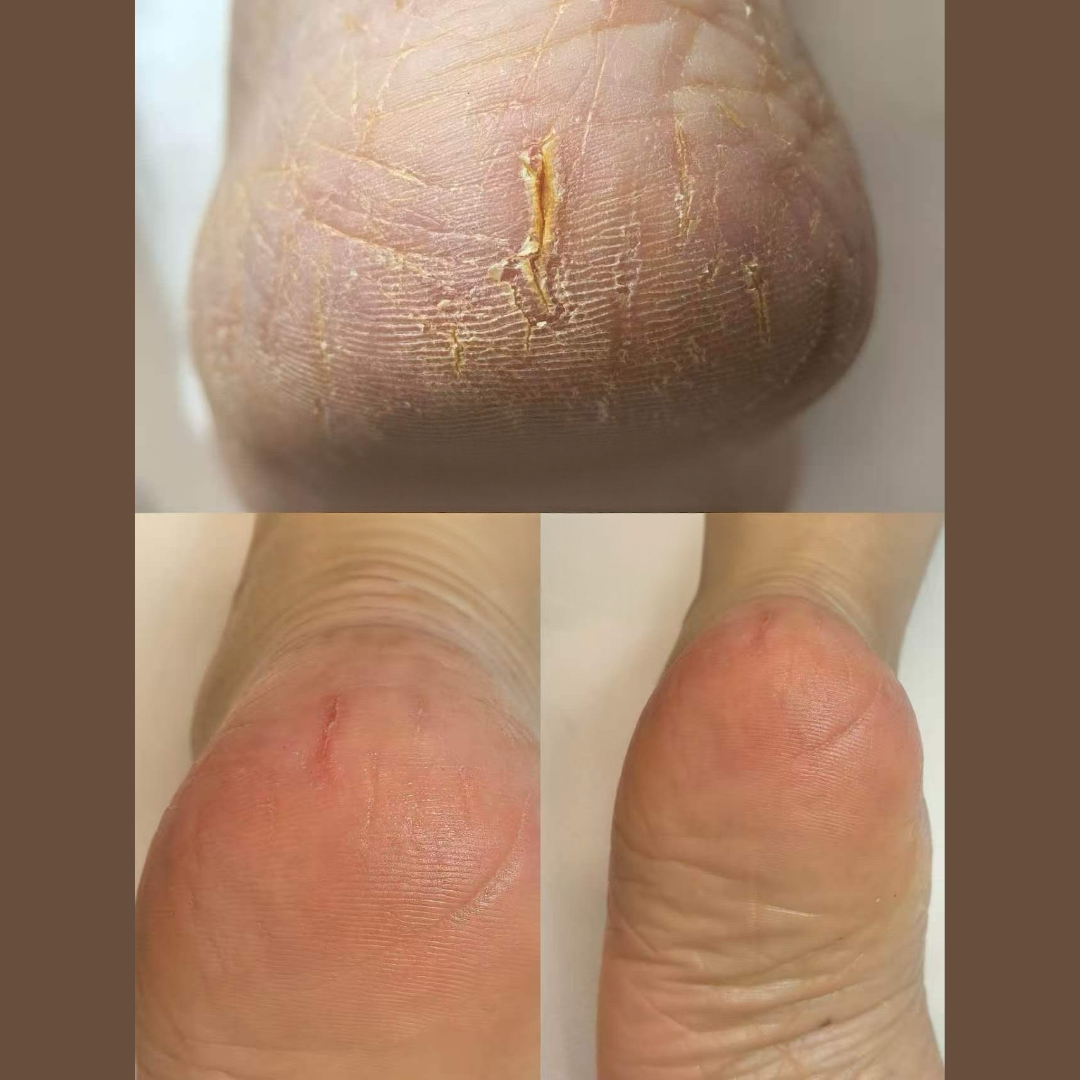 Cracked heel callus treatment before and after transformation by Colour Workshop Singapore