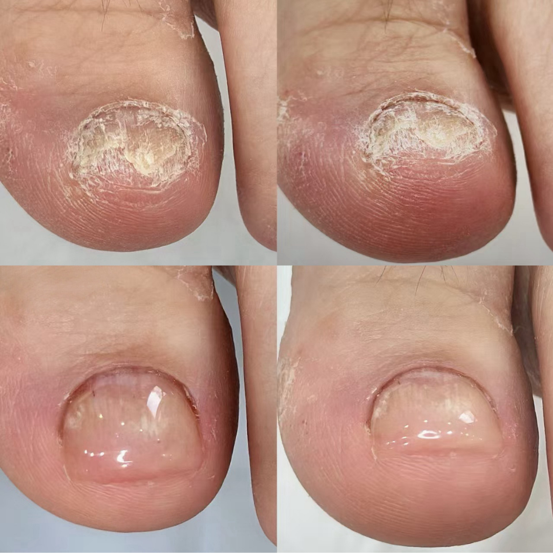 Four-panel fungal nail treatment progression showing recovery by Colour Workshop Singapore