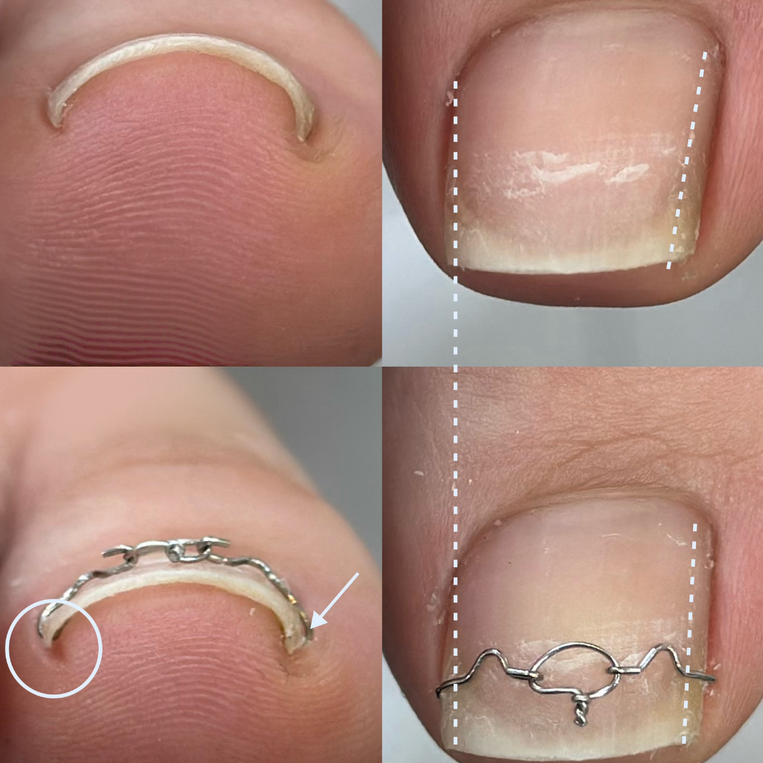 Before and after ingrown toenail correction with wire brace treatment by Colour Workshop Singapore