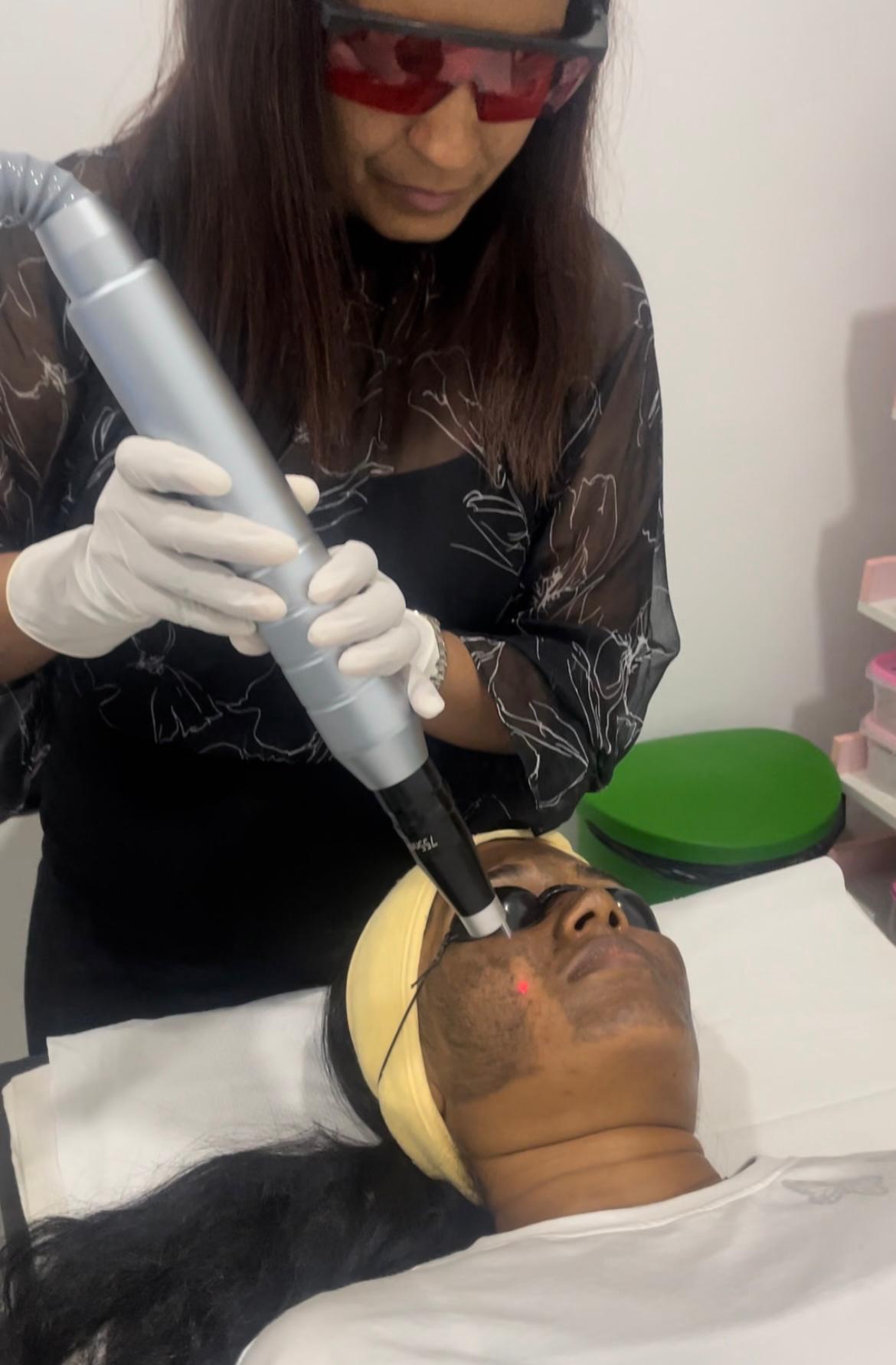 Carbon Laser Peel - Professional aesthetic treatment at The Elite Derma Care, Nugegoda