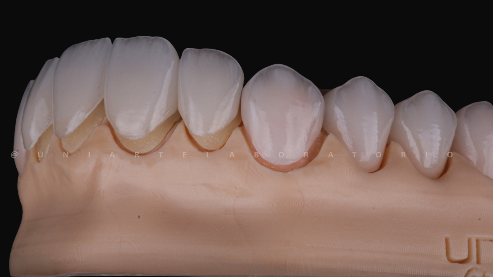 Facetas de Porcelana - Uniarte