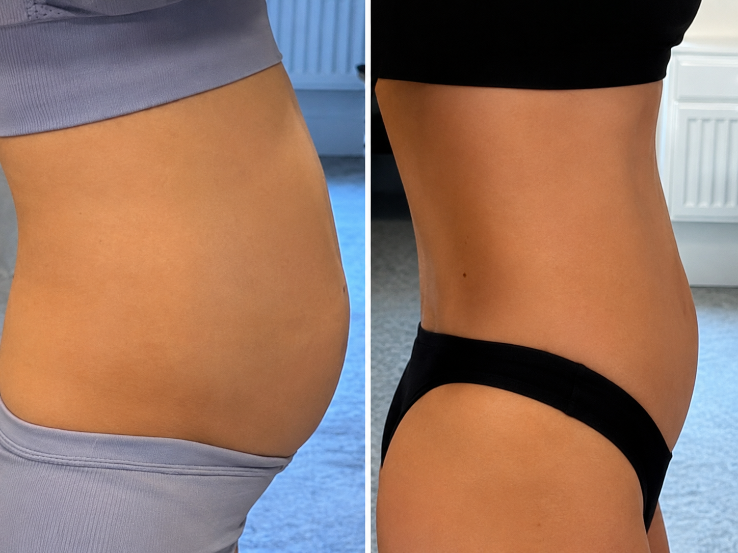 Resultado antes e depois - redução de gordura abdominal