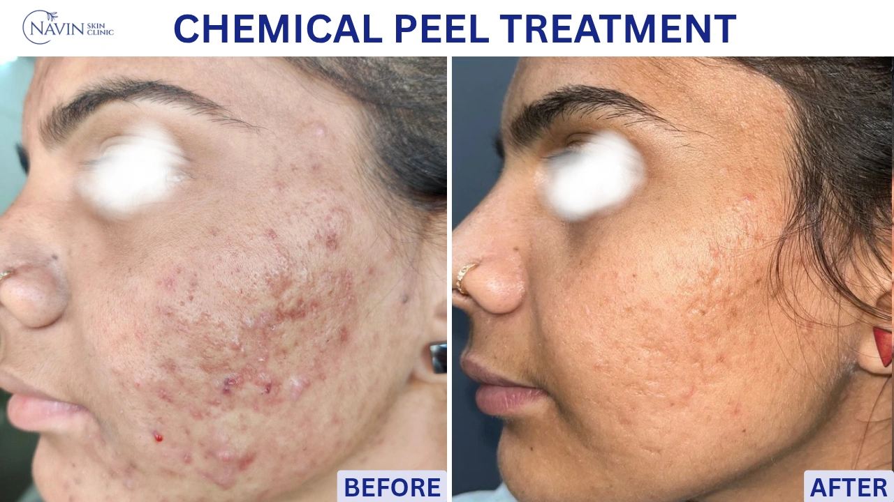 Chemical Peel Treatment - Before