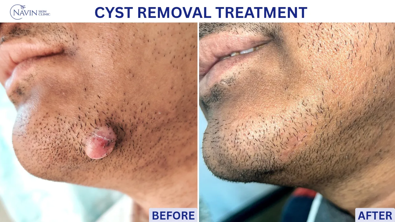 Cyst Removal Treatment - Before