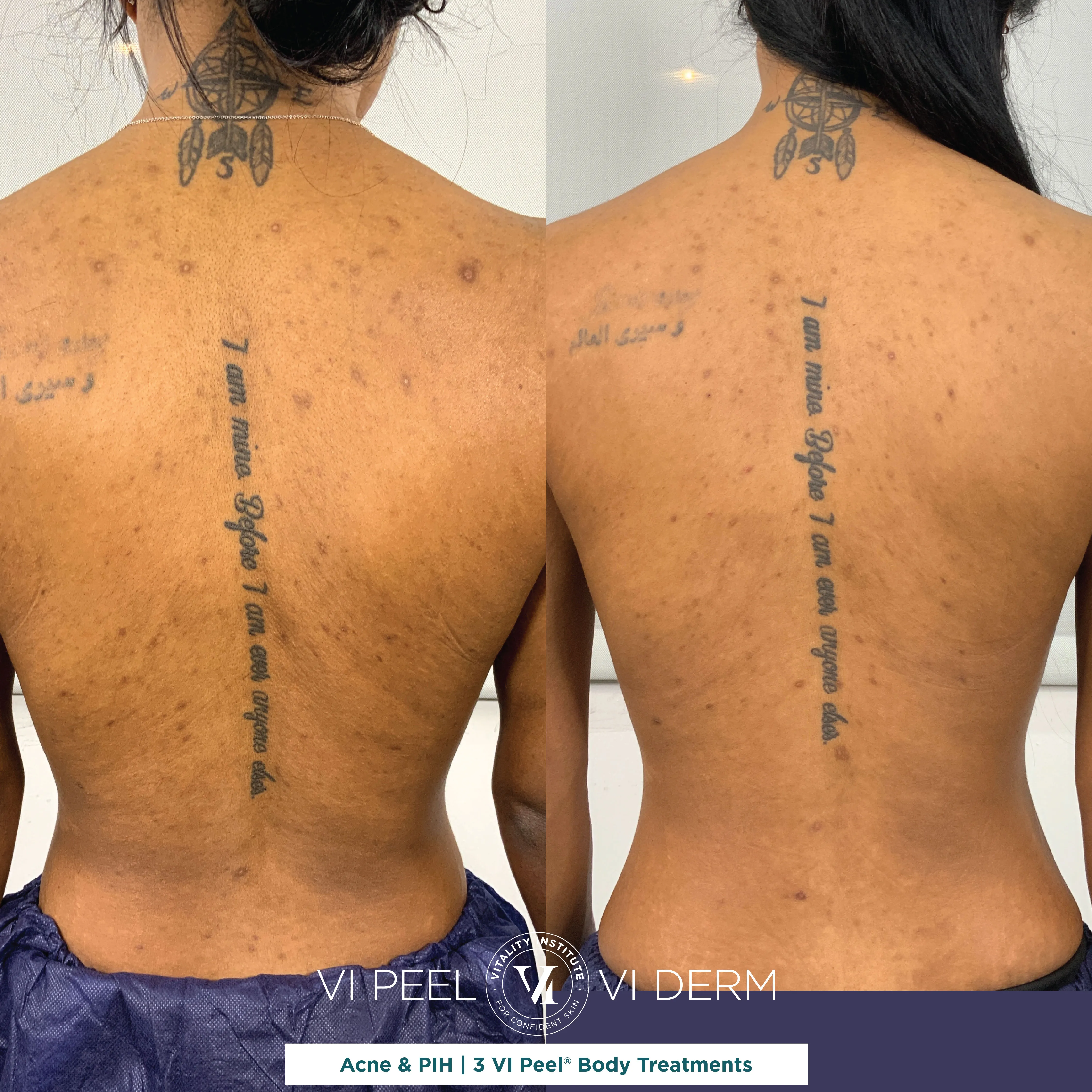 Back Acne & PIH — 3 VI Peel Body Treatments