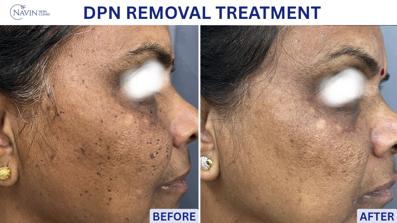 DPN Removal Treatment - Before