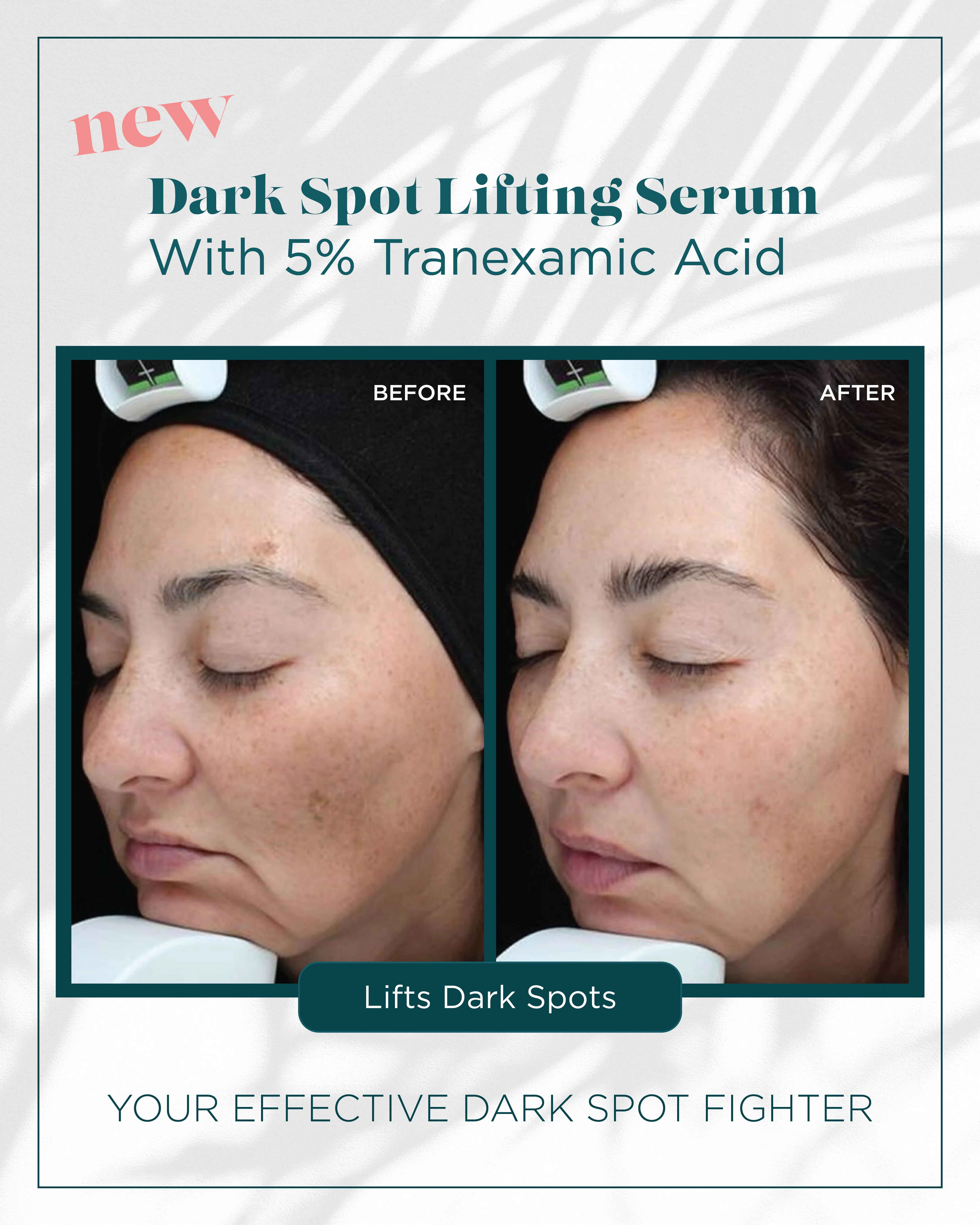 Dark Spots — Dark Spot Lifting Serum, Lifts Dark Spots (IV)