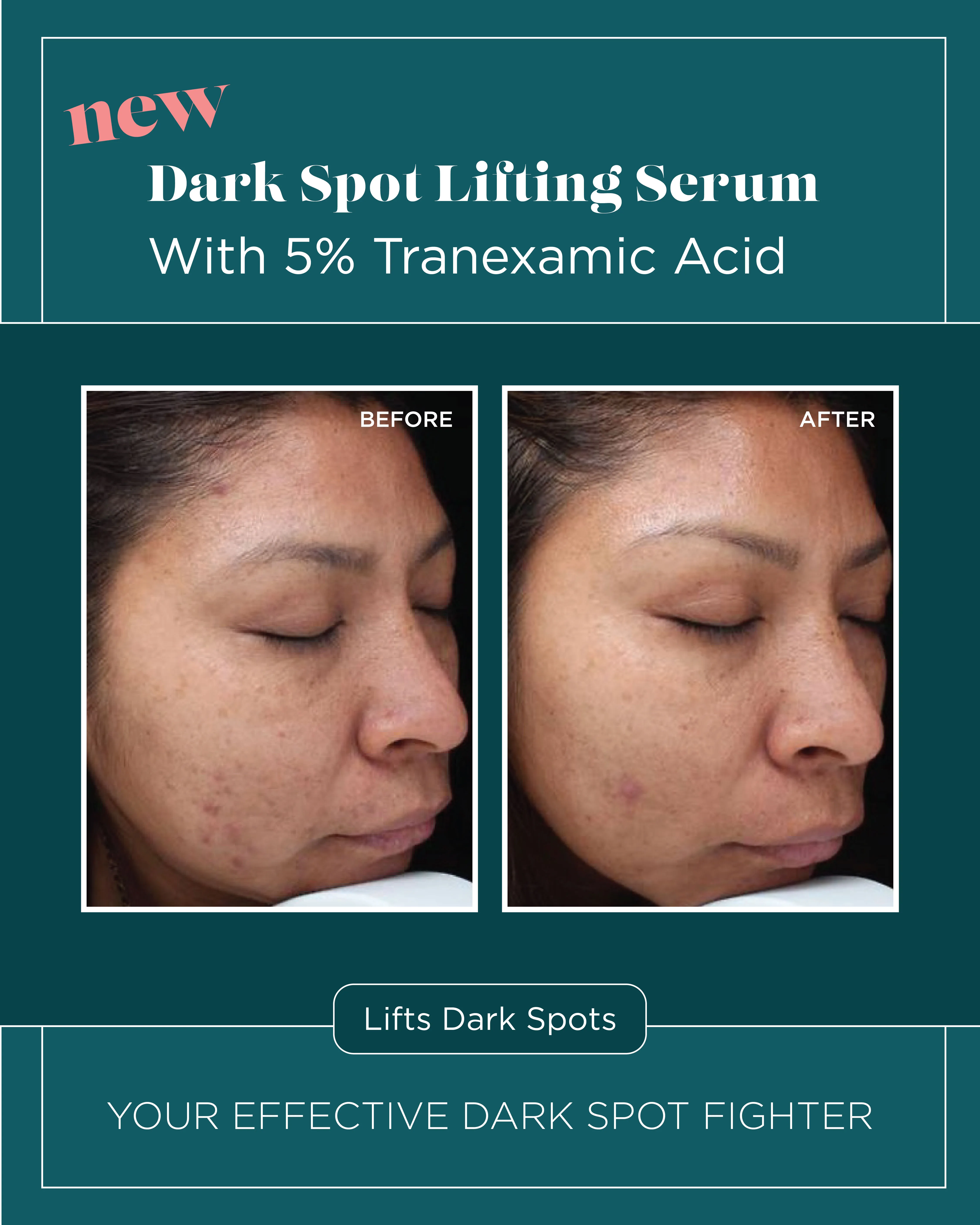 Dark Spots — Dark Spot Lifting Serum with 5% Tranexamic Acid (II)