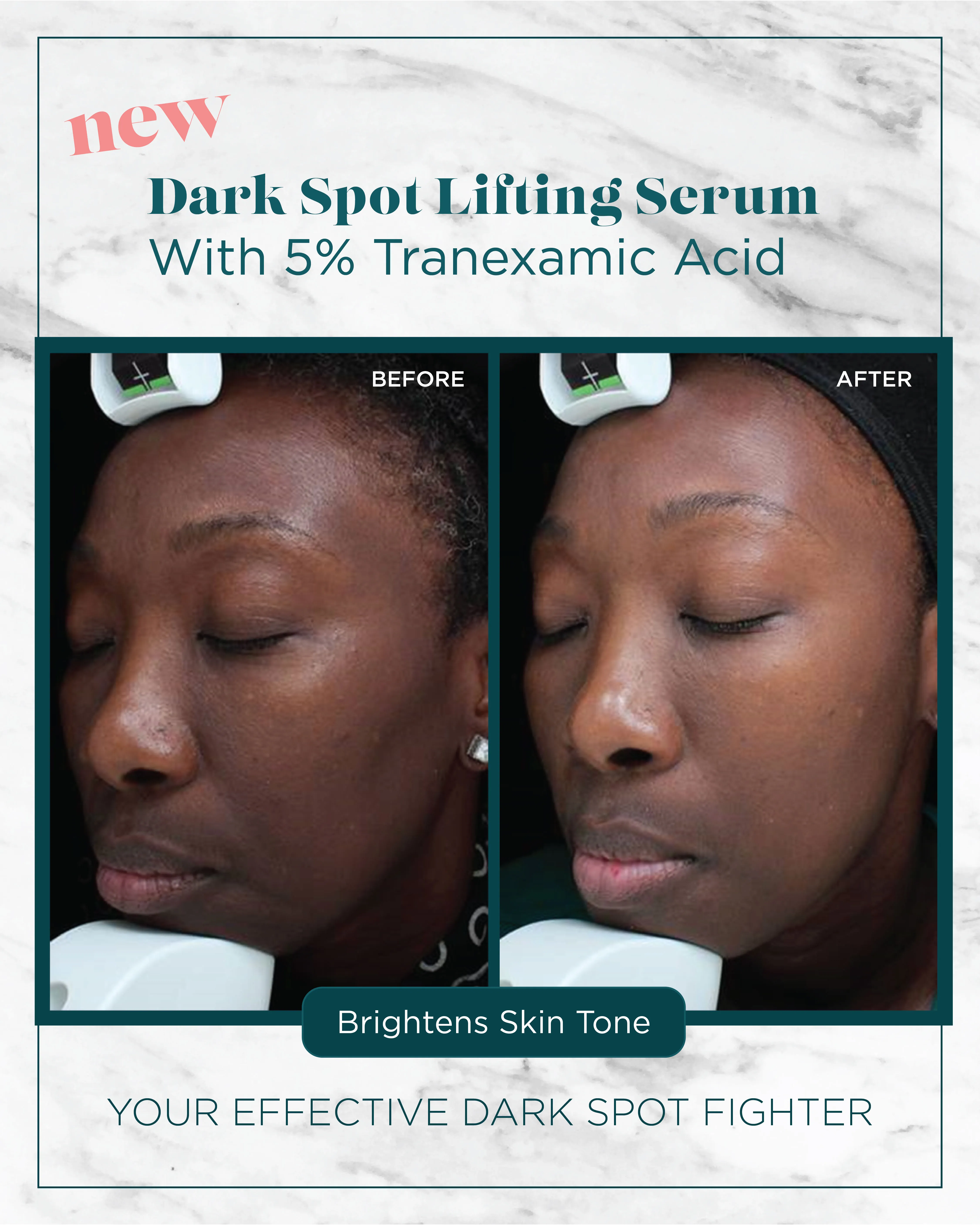 Dark Spots — Dark Spot Lifting Serum, Brightens Skin Tone (V)