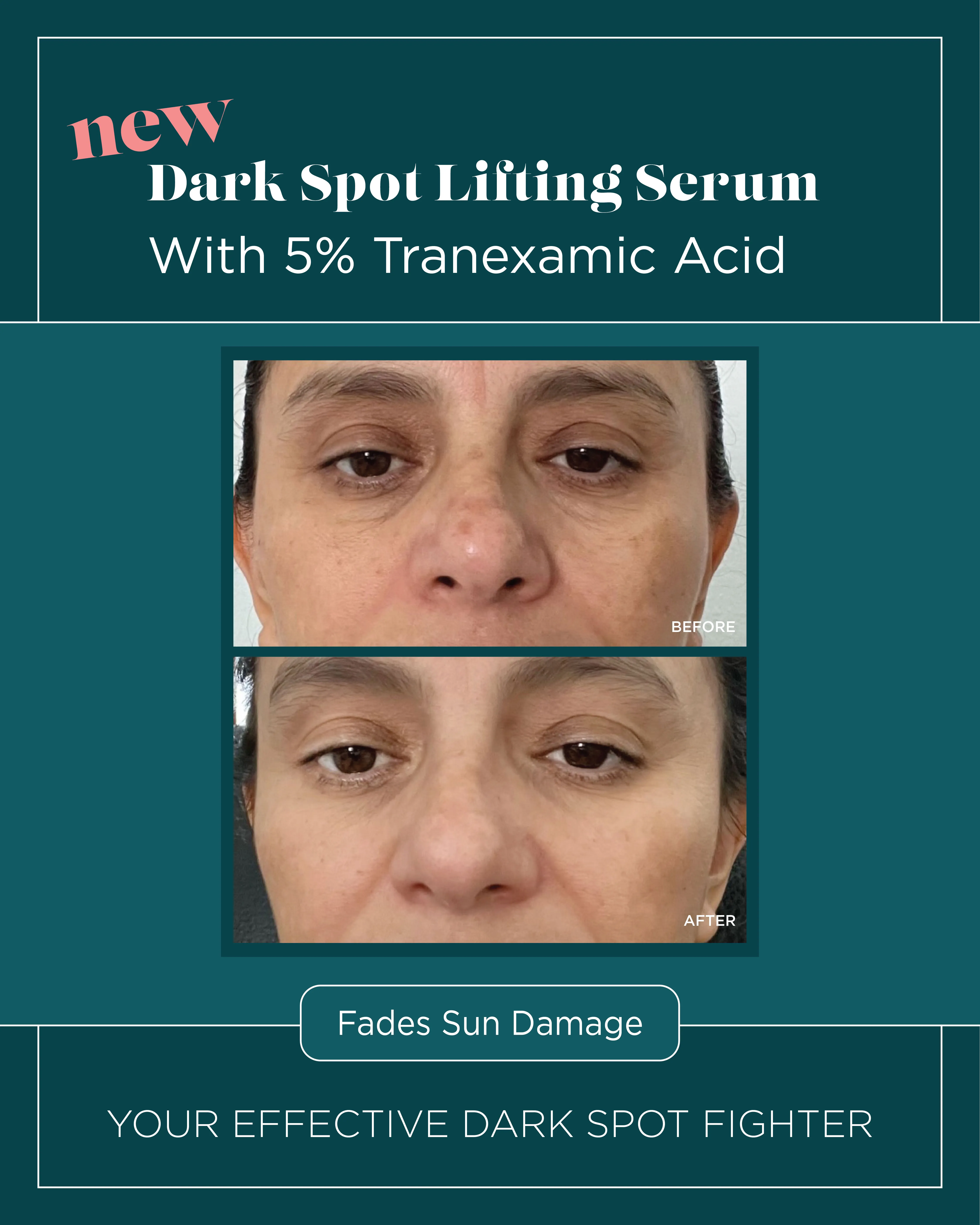 Sun Damage — Dark Spot Lifting Serum with 5% Tranexamic Acid (I)