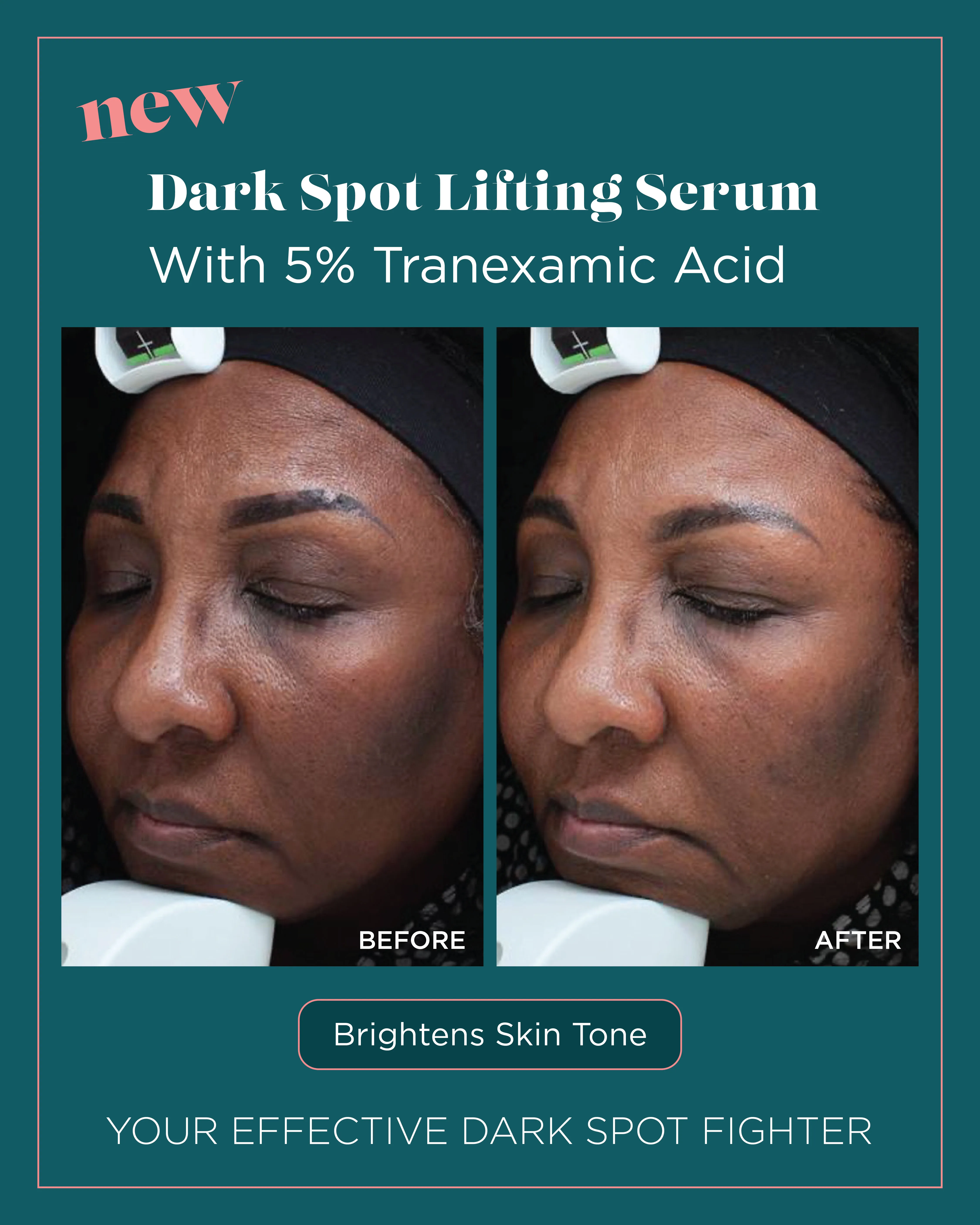 Dark Spots — Dark Spot Lifting Serum, Brightens Skin Tone (III)