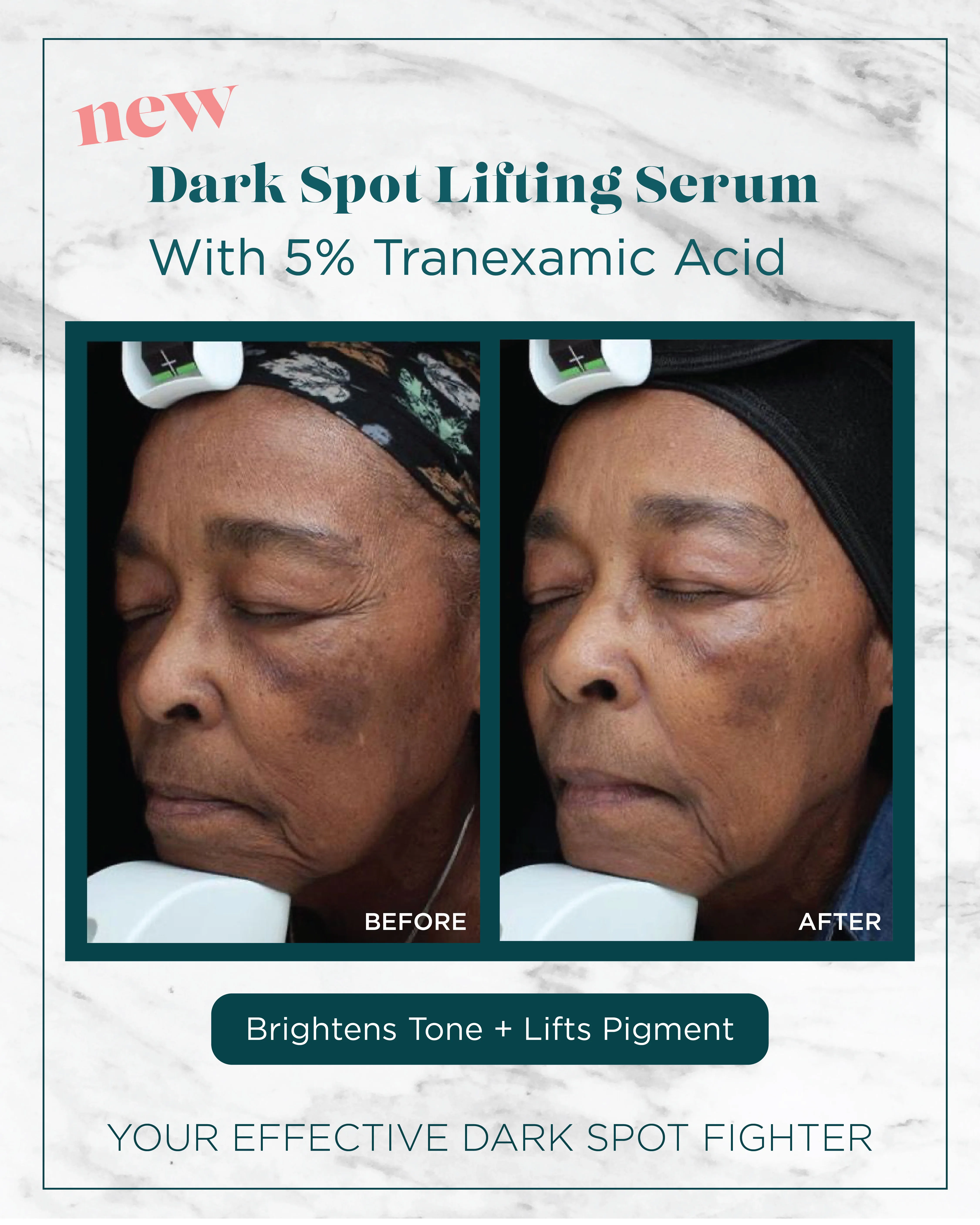 Dark Spots — Dark Spot Lifting Serum, Brightens Tone + Lifts Pigment