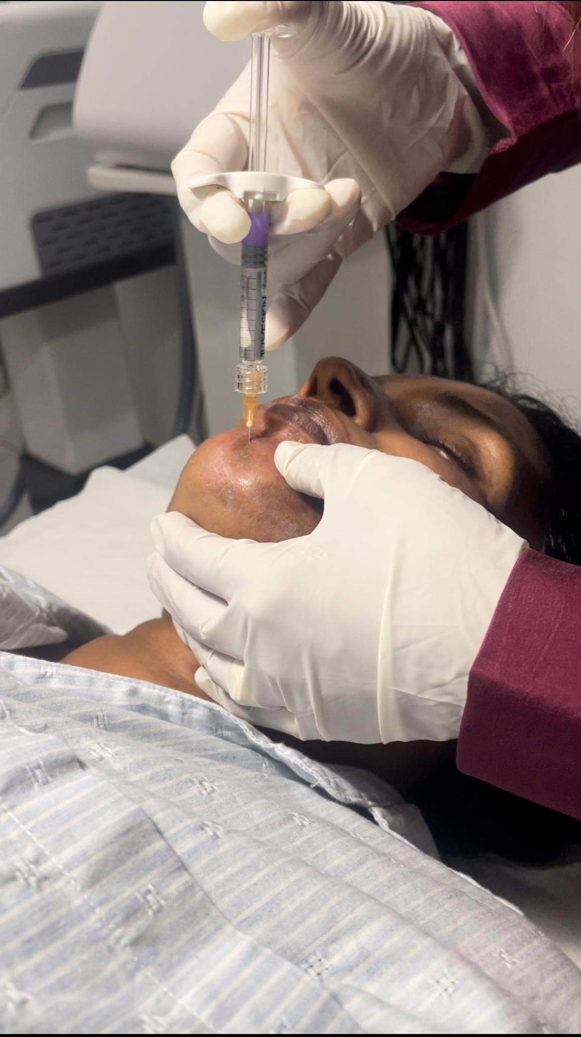 Dermal Fillers - Professional aesthetic treatment at The Elite Derma Care, Nugegoda