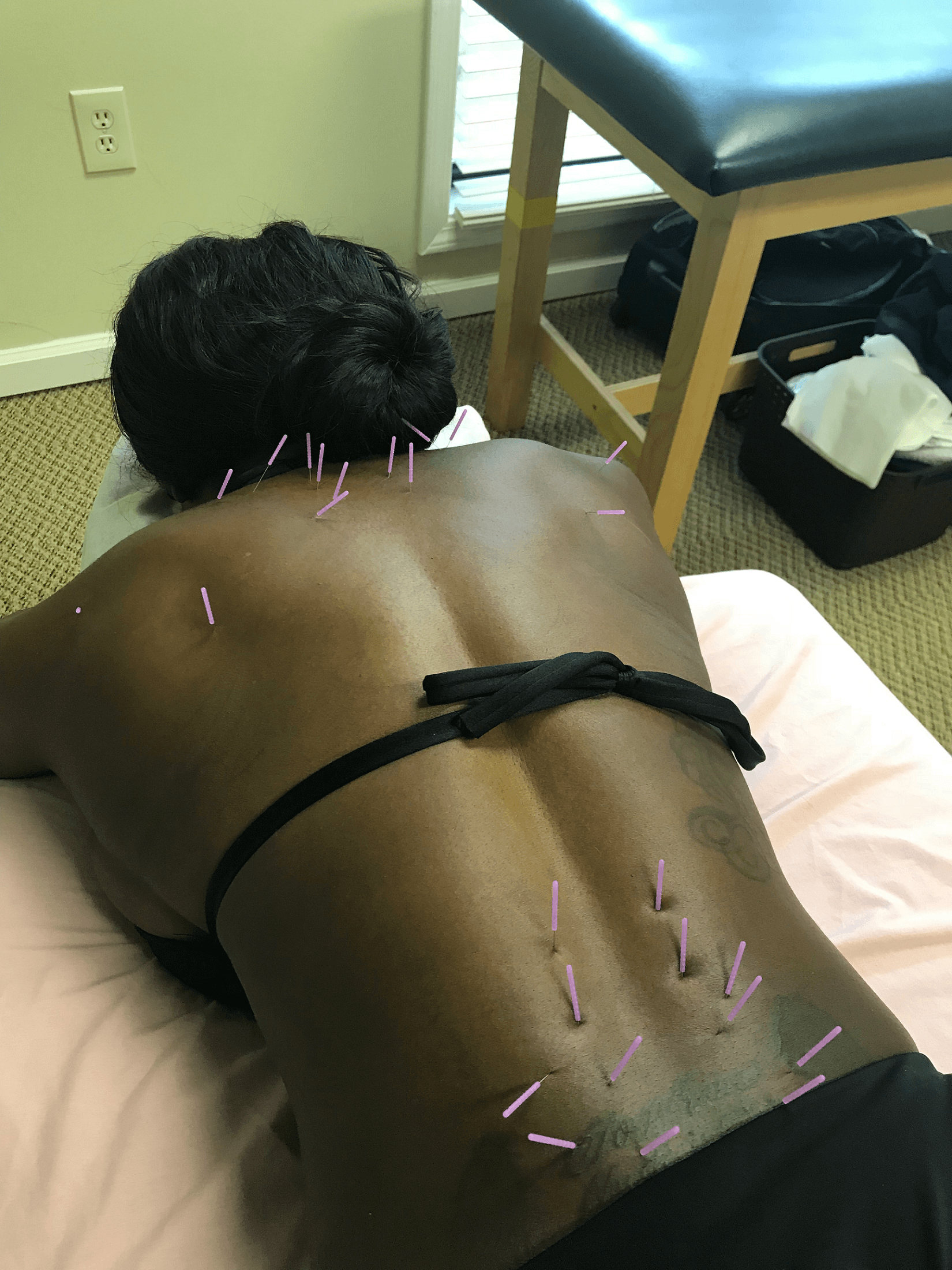 Dry needling therapy