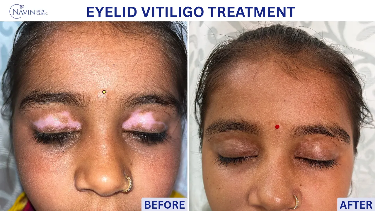 Eyelid Vitiligo Treatment - Before