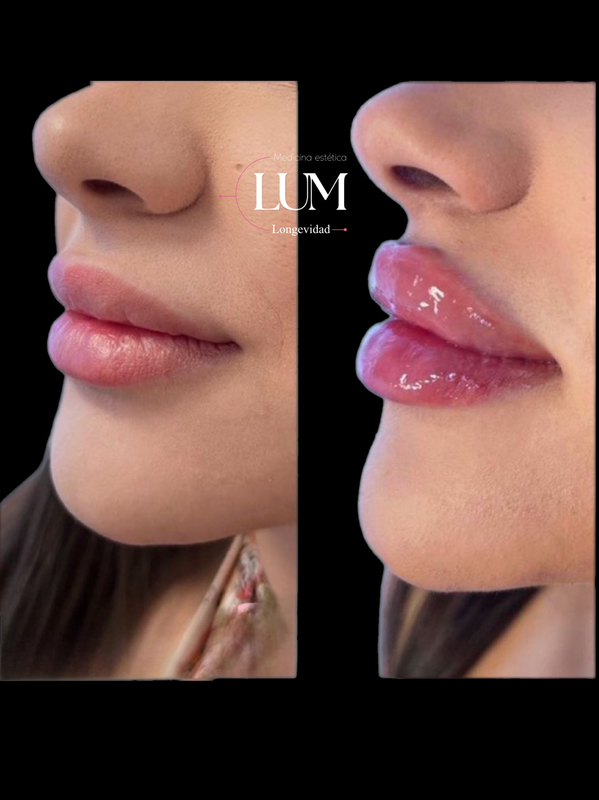 Antes y despues - Aumento de labios
