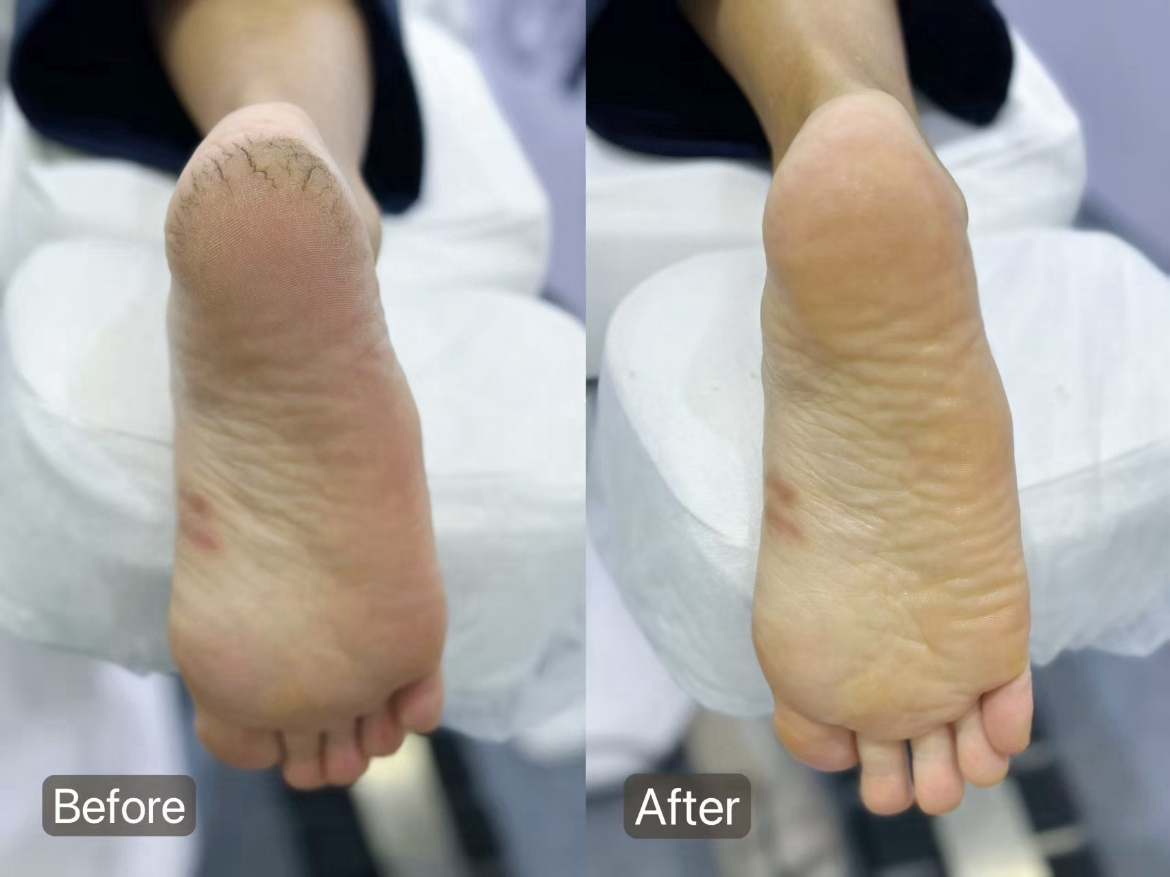 Before and after callus treatment showing cracked heel transformed to smooth skin at Colour Workshop Singapore