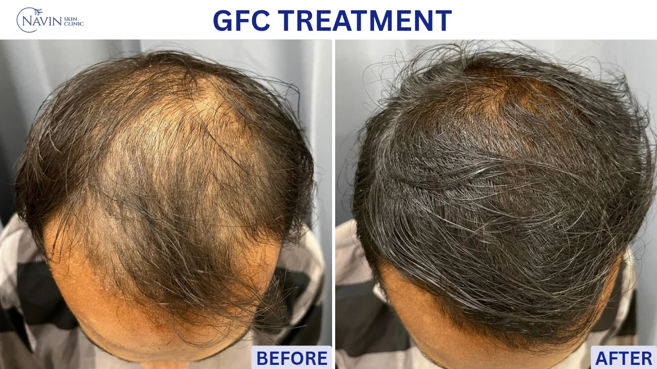 GFC Treatment - Before
