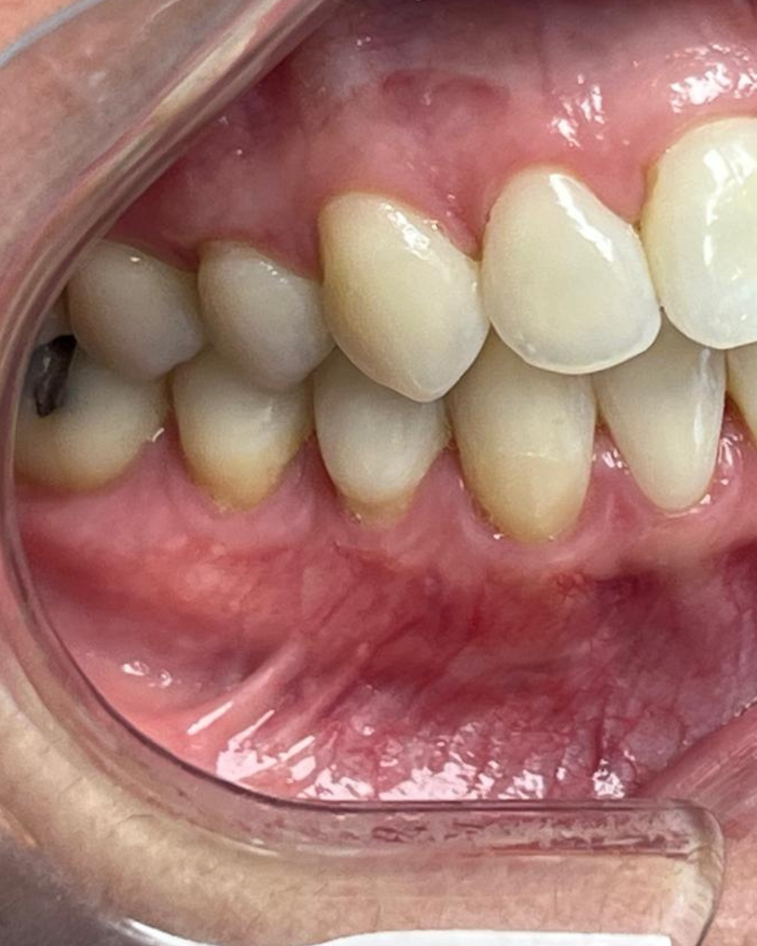 Gingival Graft after