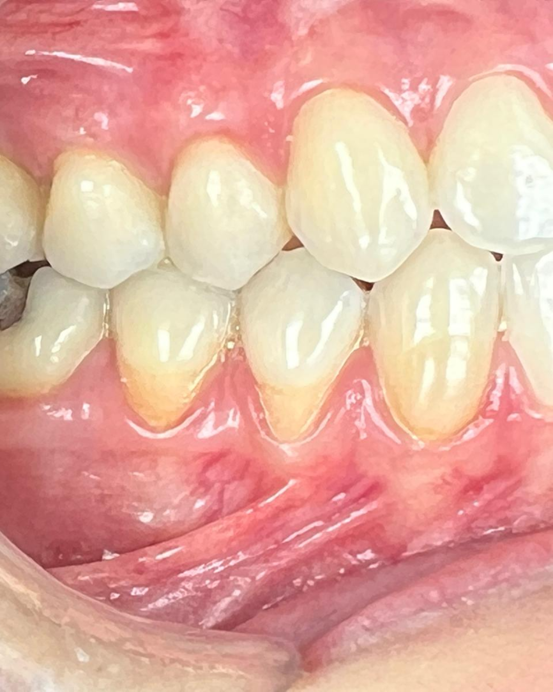 Gingival Graft before