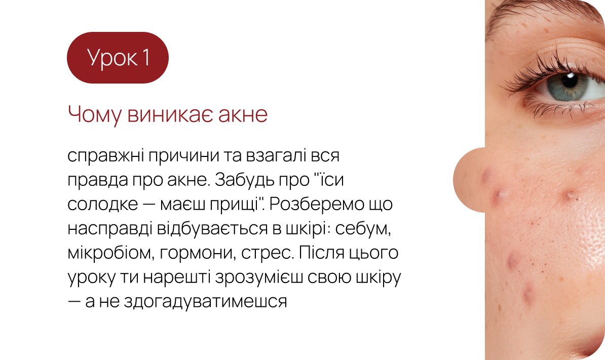 Урок 1. Чому виникає акне — справжні причини та вся правда про акне