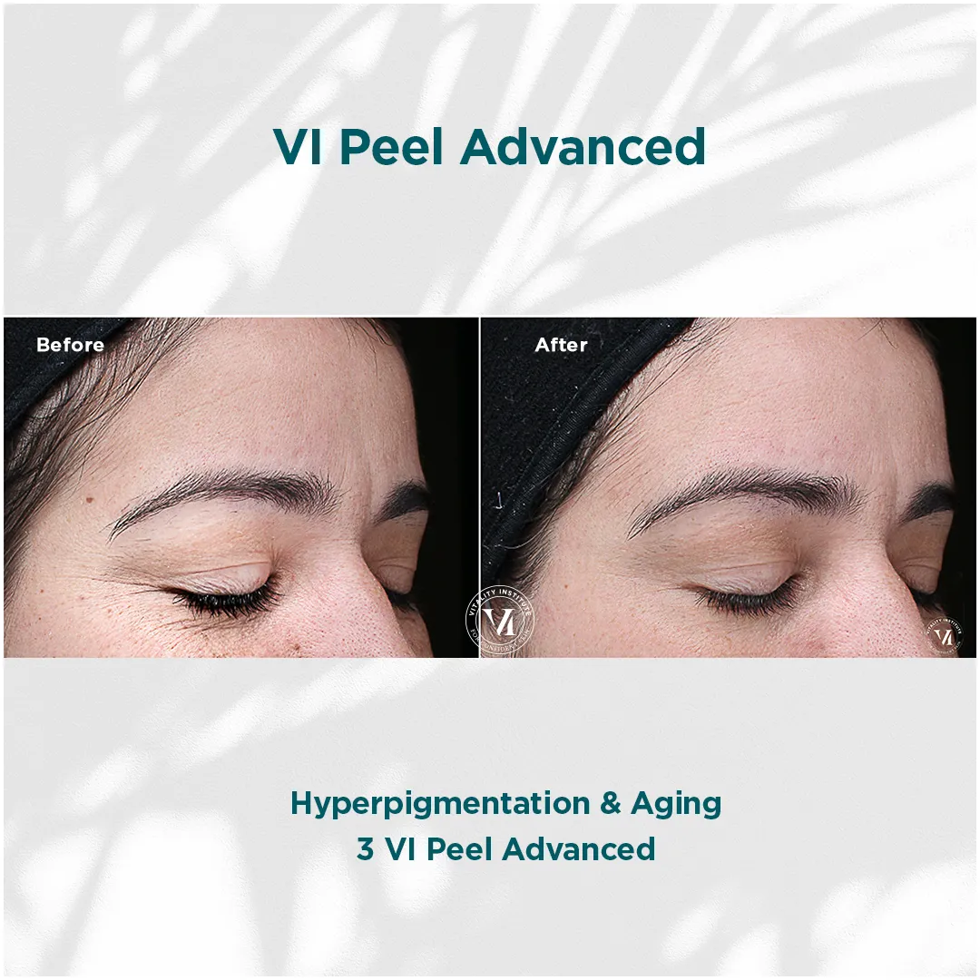Hyperpigmentation & Aging — 3 VI Peel Advanced