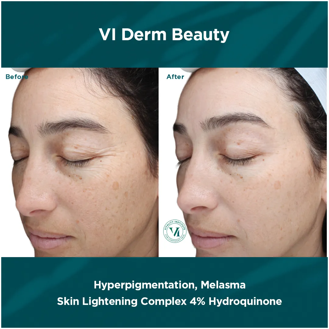Hyperpigmentation & Melasma — VI Derm Skin Lightening Complex 4% Hydroquinone