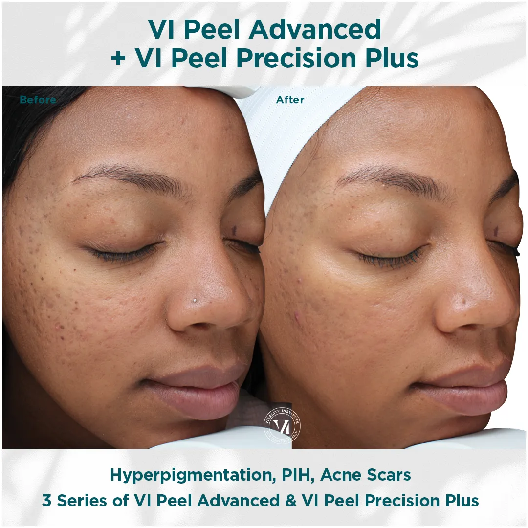 Acne, Acne Scarring & PIH — 3 VI Peel (Deep Skin Tone)