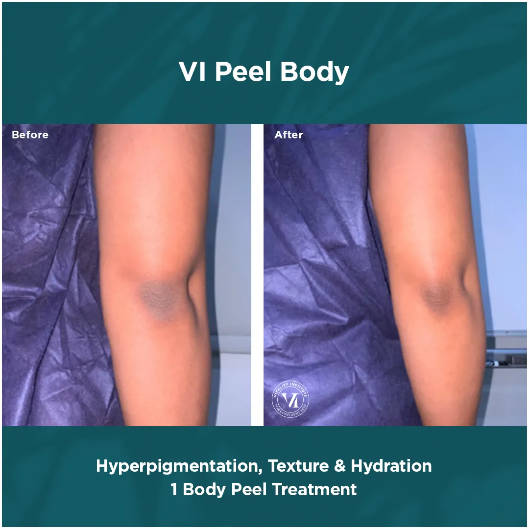 Hyperpigmentation, Texture & Hydration — 1 VI Peel Body Treatment