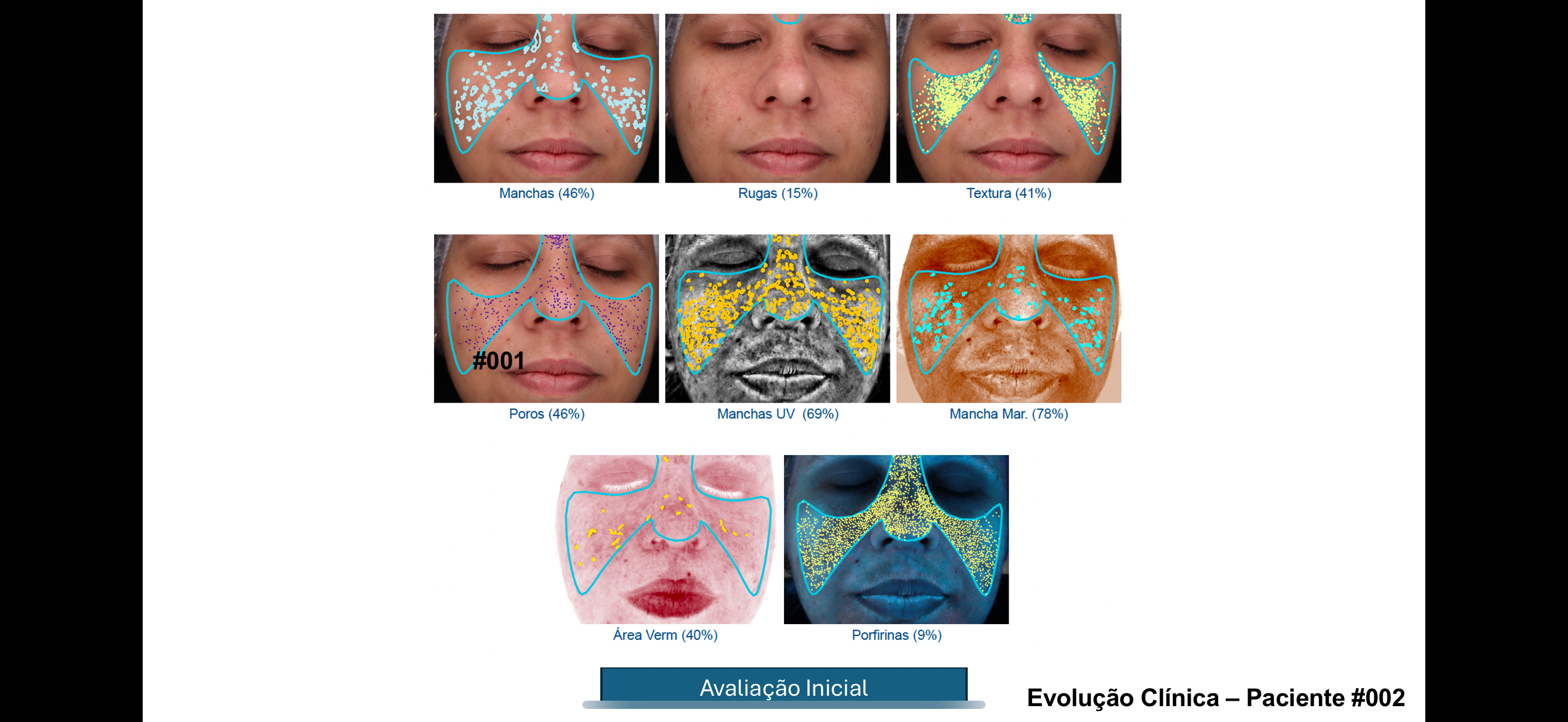 Avaliacao inicial Visia - Paciente #002 com 8 parametros de analise baseline