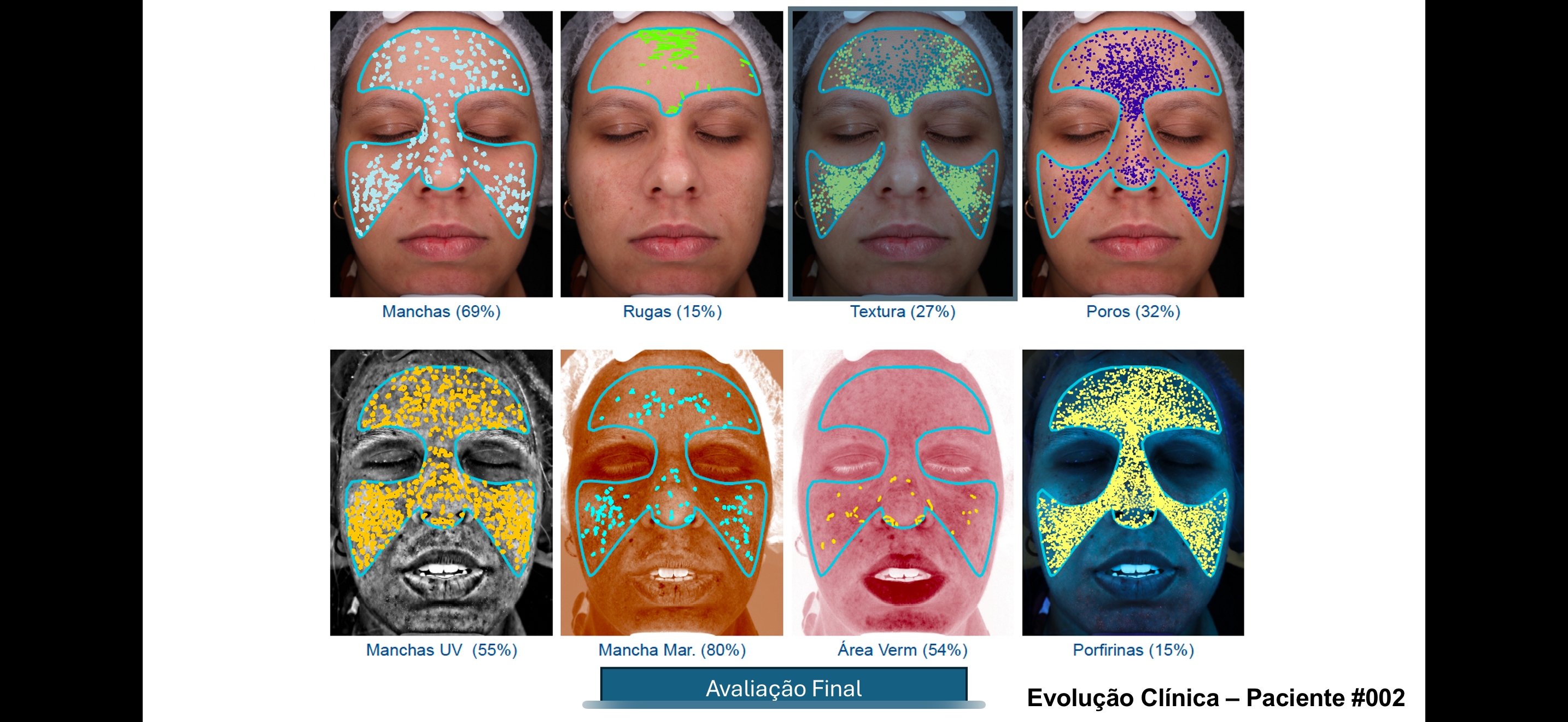 Avaliacao clinica Visia - Paciente #002 mostrando 8 parametros de analise facial antes e depois do tratamento