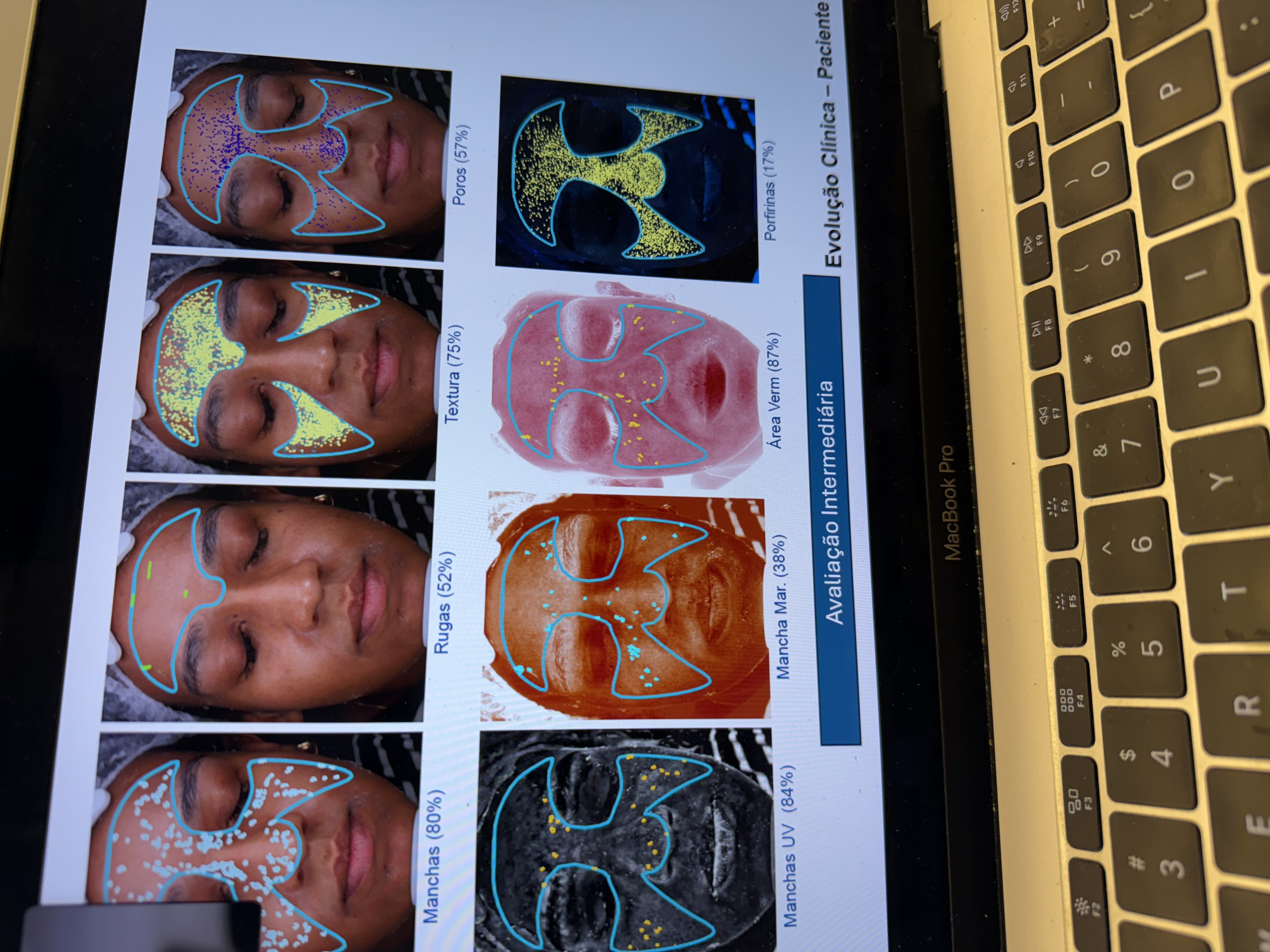 Avaliacao intermediaria Visia em notebook mostrando evolucao clinica do paciente