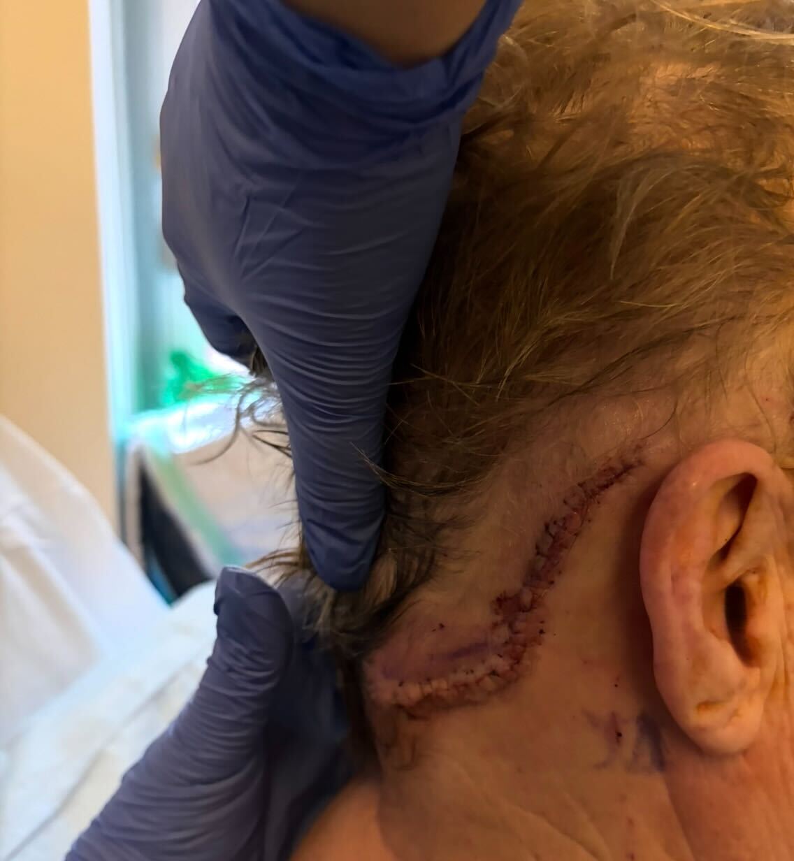 Microvascular decompression surgery scar