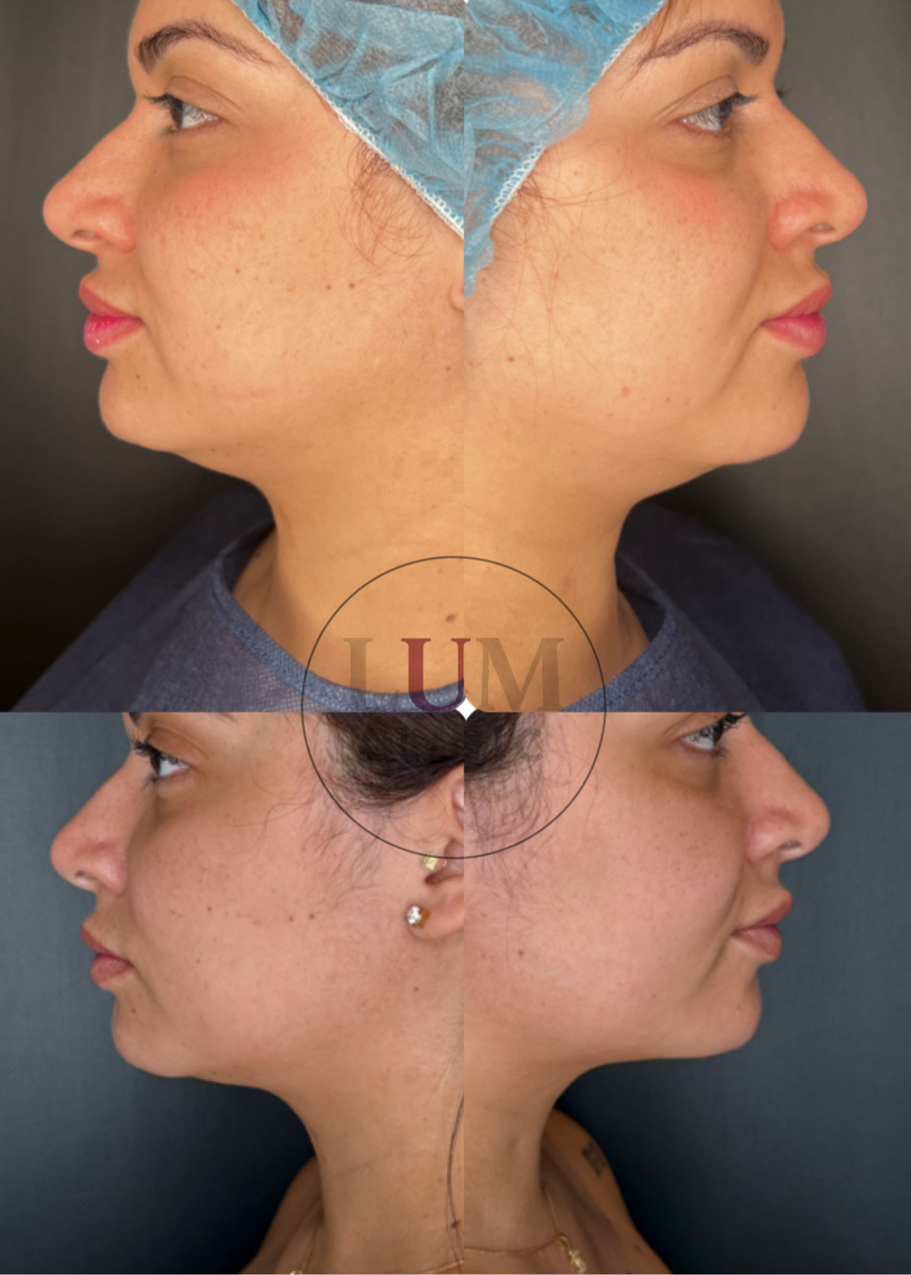 Antes y despues - Perfilado de mandibula